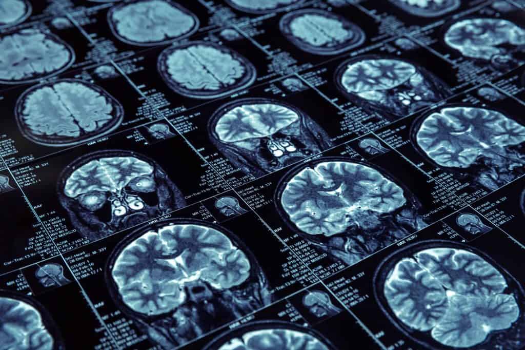 Keep It Real Episode 8: Alzheimer’s Disease
