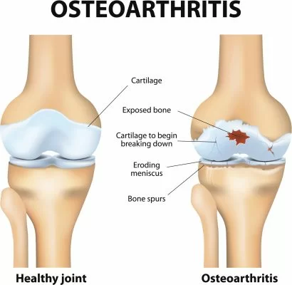 Osteoarthritis