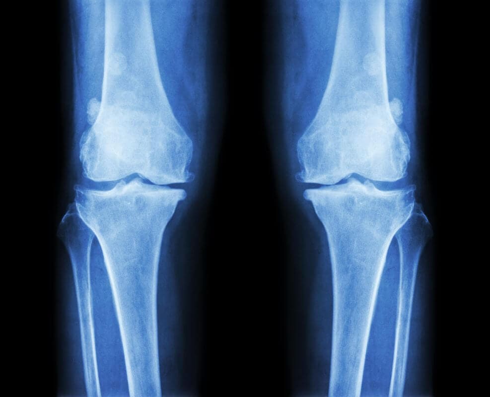 How To Decrease Risk of Osteoarthritis With 2 Simple Changes