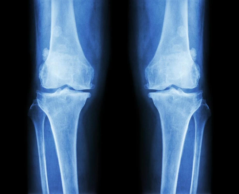 How To Decrease Risk of Osteoarthritis With 2 Simple Changes